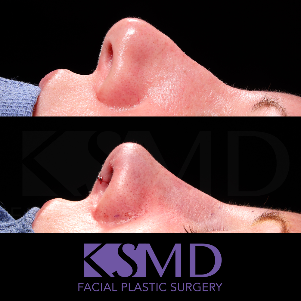 Heidi Harris Profile 2 intraop rhinoplasty