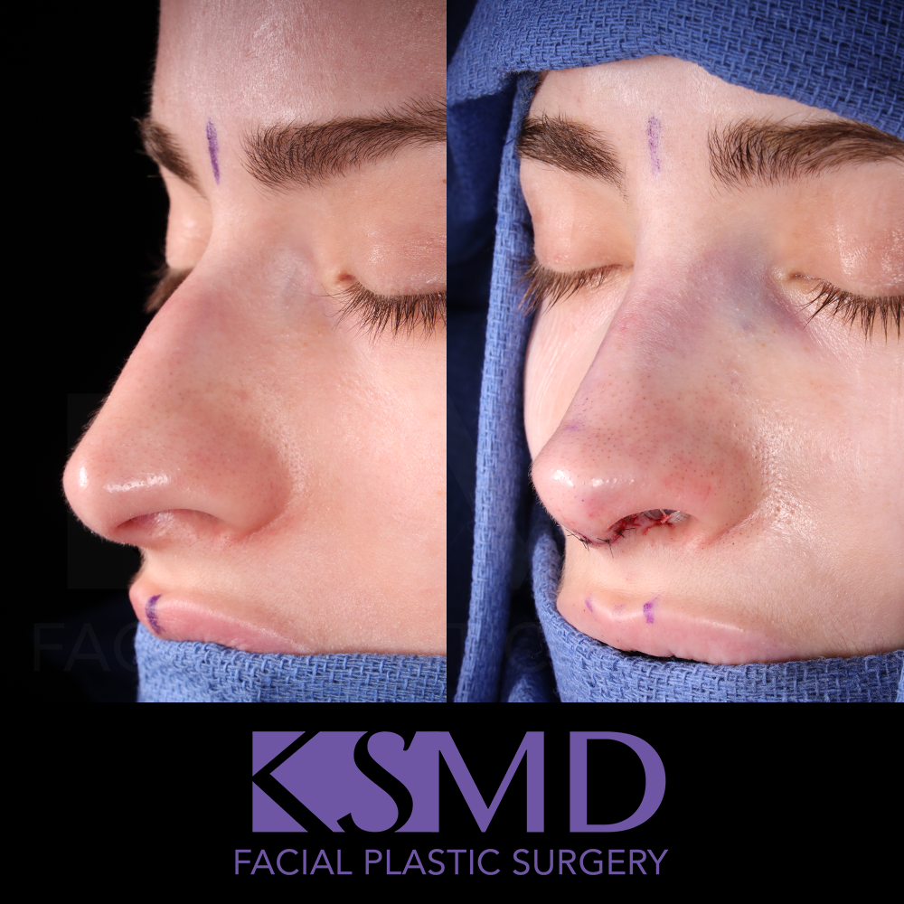 JP oblique 2 intraop