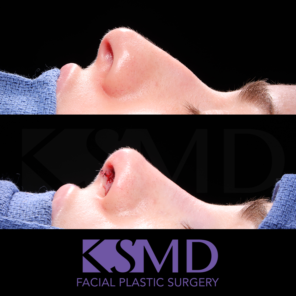 JP profile 2 intraop