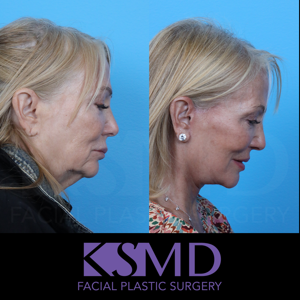 KR Profile 2 chin down