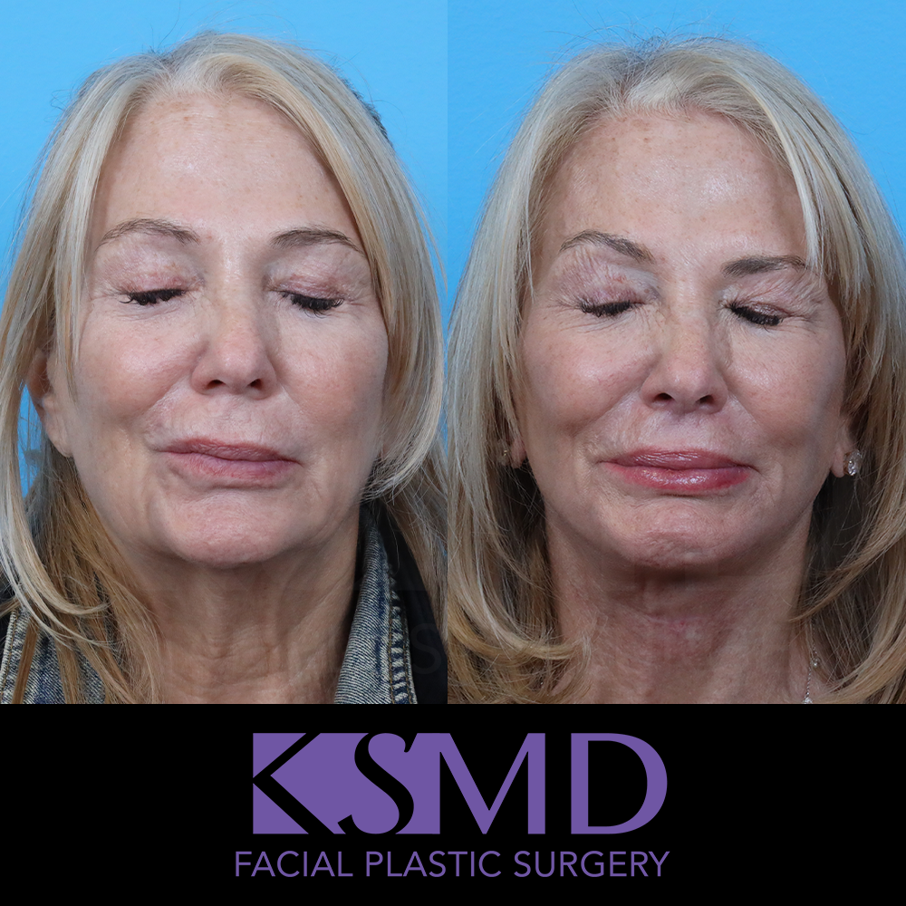 KR frontal eye closure