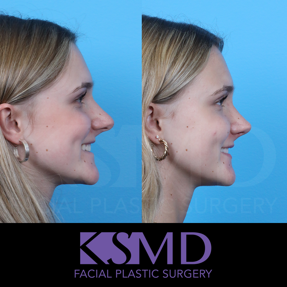 OZ 6 wk profile 2 smile