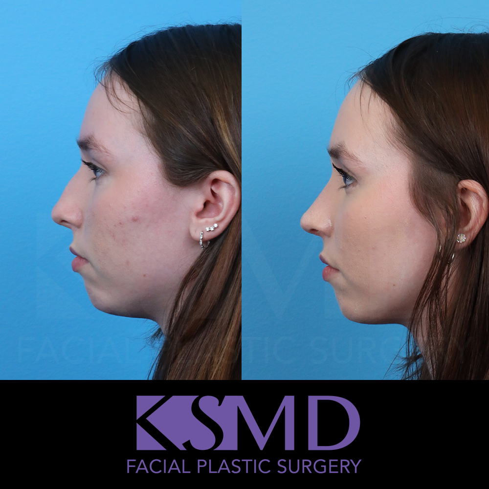 ZA profile 1 3 month