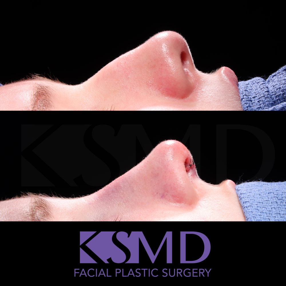 ZA profile 1 intraop