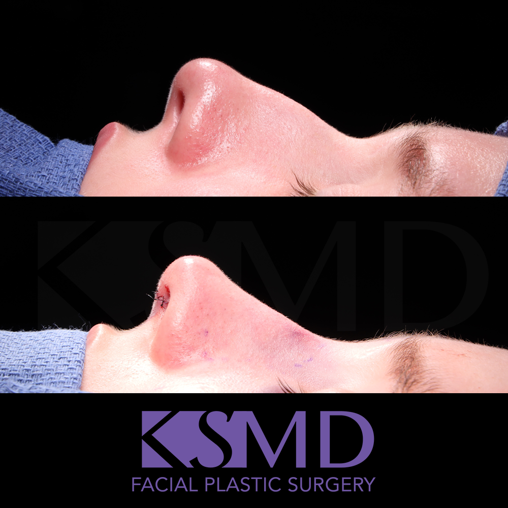 ZA profile 2 intraop